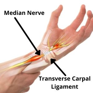 Cause of Carpal Tunnel Syndrome